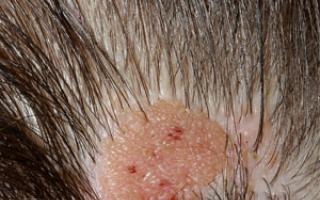 Moles (nevi) – properties, types, causes of appearance, removal, photos
