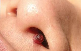 Symptoms and treatment of papilloma on the nose in a child Papilloma in the nose what to do