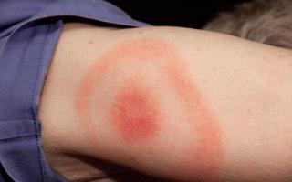 How quickly does borreliosis develop?