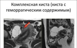 Hvordan forhindre dannelsen av en hemorragisk ovariecyste Hemorragisk corpus luteum cyste