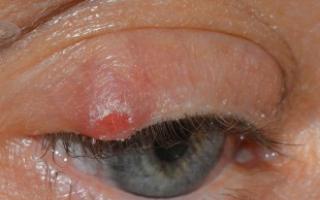 Bumps on the eyelids - causes and treatment at home